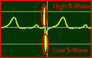 Osborn-Wave, Undetermined-PQRST-Complex