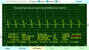 Right-Bundle-Branch-Block