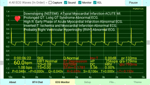 Right-Ventricular-Hypertrophy