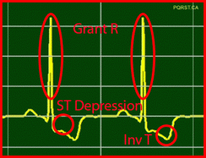 Osborn-Wave, Undetermined-PQRST-Complex