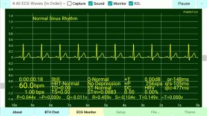 Normal-Sinus-Rhythm