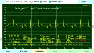 ecg/ekg-Sample