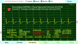 Downsloping-Myocardial-Ischemia-(NSTEMI)-Inverted-T