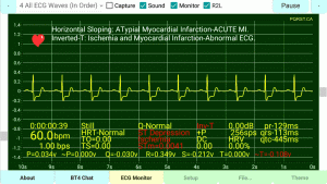 Horizontal-Sloping-Myocardial-Ischemia