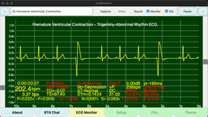 Premature Ventricular Contraction - Trigeminy 室性早搏 - 三重律