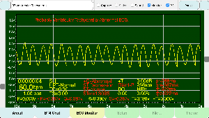 Ventricular-Tachycardia