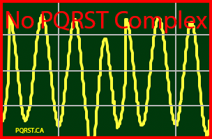 Ventricular-Fibrillation, Undetermined-PQRST-Complex