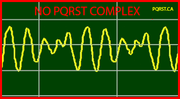 Osborn-Wave, Undetermined-PQRST-Complex